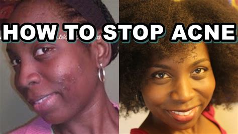 How To Stop Acne Naturally My Acne Story Youtube