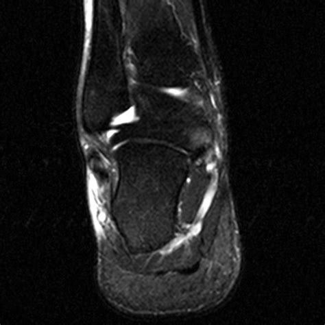 Radiologia Do Esporte Ruptura Parcial Do Ligamento Calcaneofibular