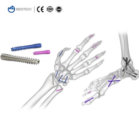 Orthopedic Implants Titanium Medical Bone Screws Cannulated Headless