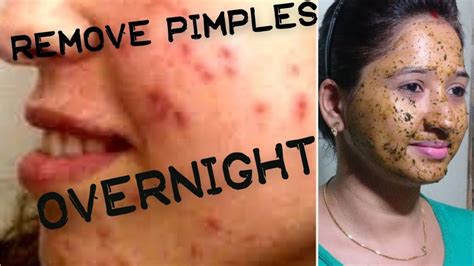 New How To Remove Pimples Overnight Acne Treatment 2017 Youtube