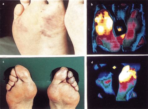 Black White Area Of Erythromelalgia In The Right Foot In Case 3 Jps
