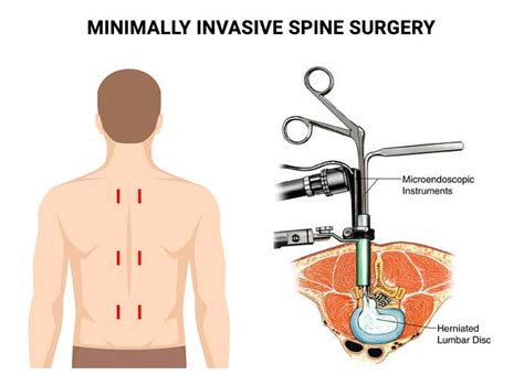 Minimally Invasive Spine Surgery Advancements And Recovery By