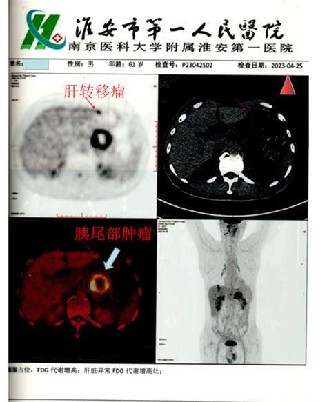 胰腺癌肝转移伴癌痛海扶刀治疗病例 陈谦主治医师 爱问医生