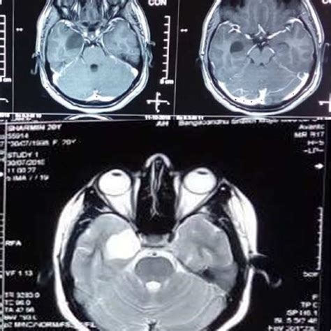 Arachnoid Cyst In Right Temporal Lobe Download Scientific Diagram