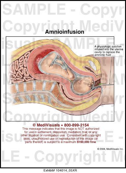 Amnioinfusion-OB Nursing Pins, Ob Nursing, Nursing Quotes, Maternity ...