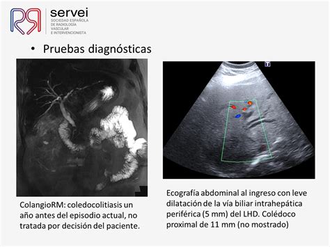 Litotricia Percutánea Con Láser Holmium Para El Tratamiento De La