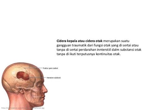 Asuhan Keperawatan Cidera Kepala