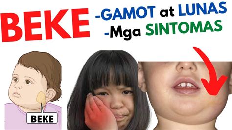 Gamot AT Lunas Sa BEKE At Mga SINTOMAS Beke O MUMPS Sa BATA Matanda