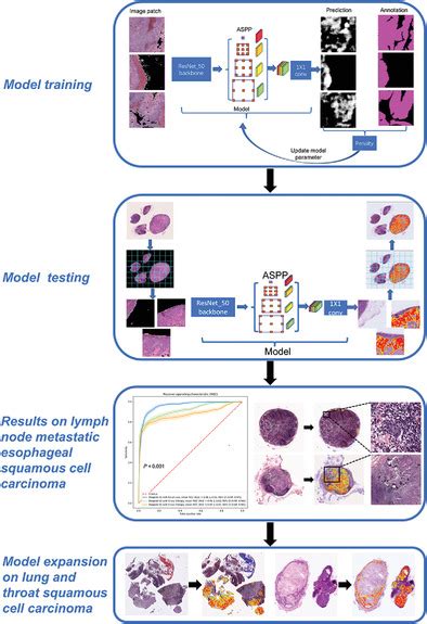 Automatic Detection Of Squamous Cell Carcinoma Metastasis In Esophageal Lymph Nodes Using