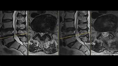 Ube L4 5 Lt Ulbd For Central Stenosis Youtube