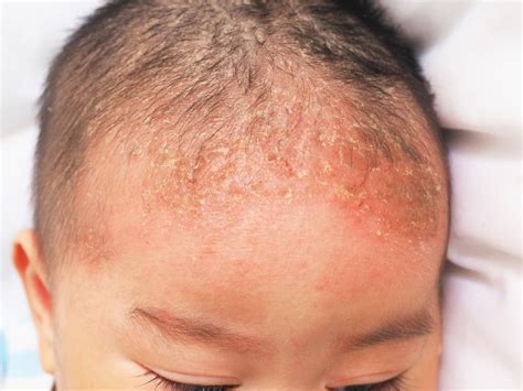 Dermatitis Pada Bayi Penyebab Gejala Perawatan