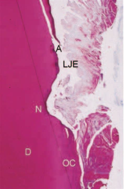 Figure 1 From Clinical And Histologic Evaluation Of Human Intrabony