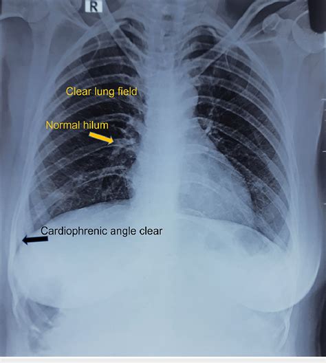 Chest X Ray Pa View Showing Clear Lung Fields Pa Posteroanterior