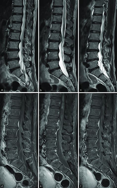 Magnetic Resonance Imaging Of The Lumbosacral Spine Sequential