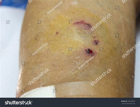 Dog Bite Wound. Stock Photo 350333876 : Shutterstock