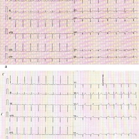 Serial Electrocardiogram ECG Showing A Normal Sinus Rhythm With Left