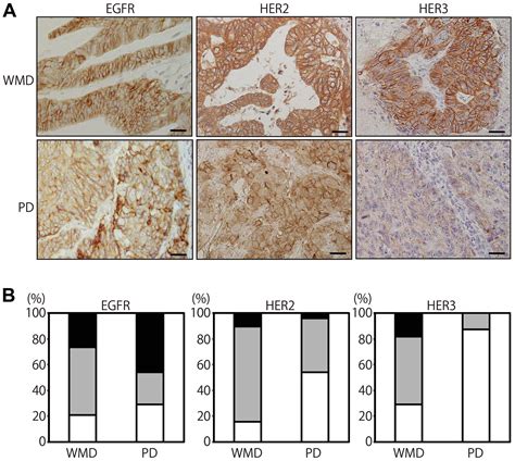 Deficient Her3 Expression In Poorly Differentiated Colorectal Cancer