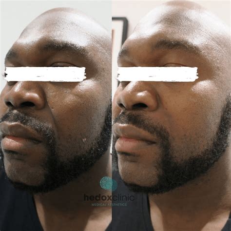 Nasolabial Folds Treatment London Nasal Fold Filler Hedox Clinic