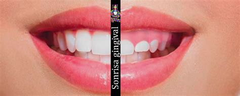 Soluciones Para Tu Sonrisa Gingival Cl Nica Dental De Ni Os Y