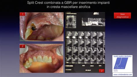 Dr Daviso Dental Blog Split Crest Mediante Piezochirurgia Combinato A