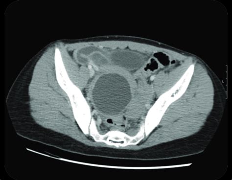 Pelvic Computed Tomography Axial Plane With Cystic Formation With Download Scientific