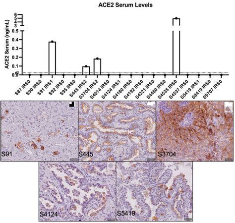 Cancers Free Full Text Expression Of SARS CoV 2 Related Surface