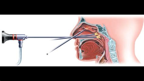 Nasal Endoscopy CPT Code Simplify Medical Coding YouTube