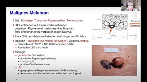 Hautkrebs Chancen Und Herausforderungen Beim Melanom Und Therapie