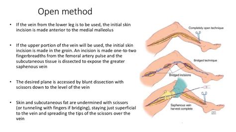 Saphenous Vein Harvesting