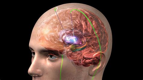 Cirugía de estimulación cerebral profunda alivio para los temblores de