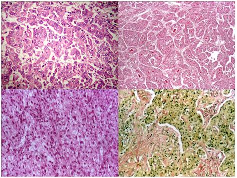 Hepatocellular Carcinoma Histology