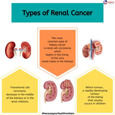 Differences In Types Of Kidney Cancer Nbkomputer