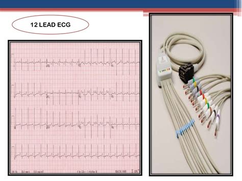 Tricuspid valve stenosis