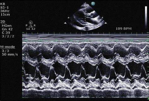 Echocardiographic Assessment Of Pericardial Disease Thoracic Key