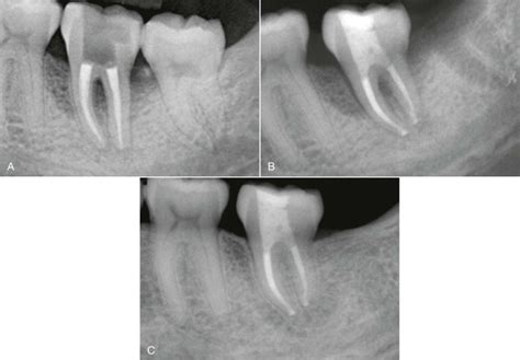 Evaluation Of Endodontic Outcomes Pocket Dentistry