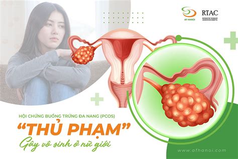 Hội chứng buồng trứng đa nang PCOS thủ phạm gây vô sinh ở nữ giới