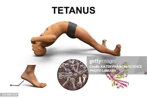 Clostridium Tetani Symptoms