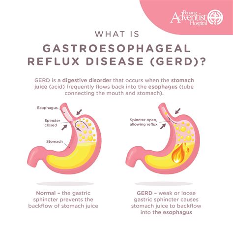 National Cancer Society Of Malaysia Penang Branch Gastroesophageal