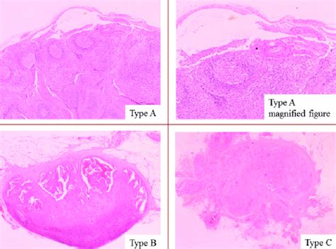 Figure Representative Figures Of The Histopathologic Patterns Of D