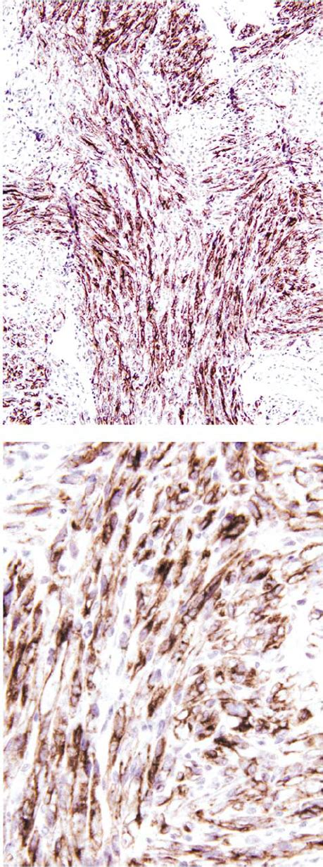 D2 40 Staining Results In Kaposiform Hemangioendothelioma Case 24