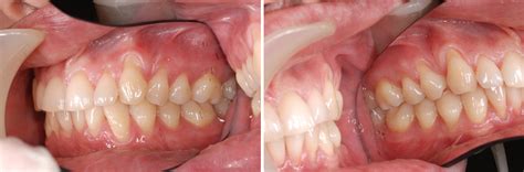 Case Study: Toothbrush abrasion – significant damage - Caring 4 Smiles