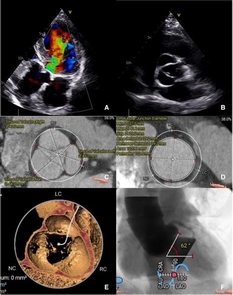 A The Preoperative Transthoracic Echocardiogram In Diastole Showing Download Scientific