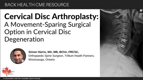 Cervical Disc Arthroplasty A Movement Sparing Surgical Option In