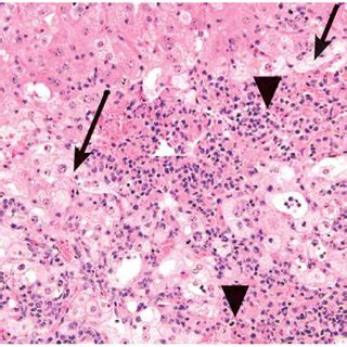 Splenic White Pulp Atrophy The Arrows Indicate Reduced Lymphoid Cells