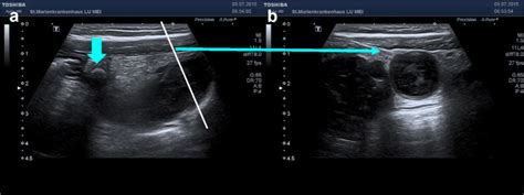 Classification Of Acute Appendicitis Caa Type 2a On Ultrasound Download Scientific Diagram