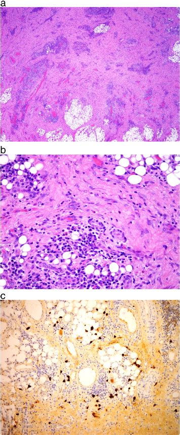 A Low Power View Shows Prominent Chronic Inflammation Dense Fibrosis