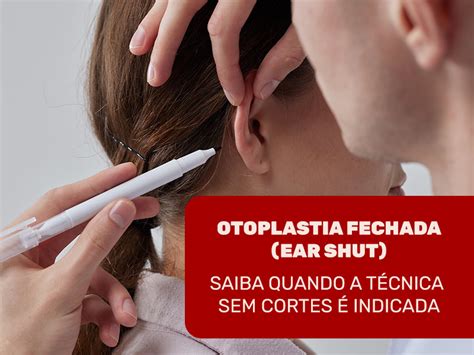 Otoplastia Como Feita A Cirurgia Na Orelha Dream Plastic