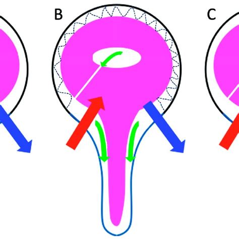 Hemohydrodynamic Interactions In Chronic Hydrocephalus A In Download Scientific Diagram