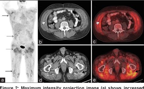 Figure From A Rare Case Of Sarcoidosis Presenting As Diffuse