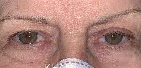 33 Upper Eyelid Surgery Before And After Photos Dallas Plano Texas Cosmetic Reconstructive